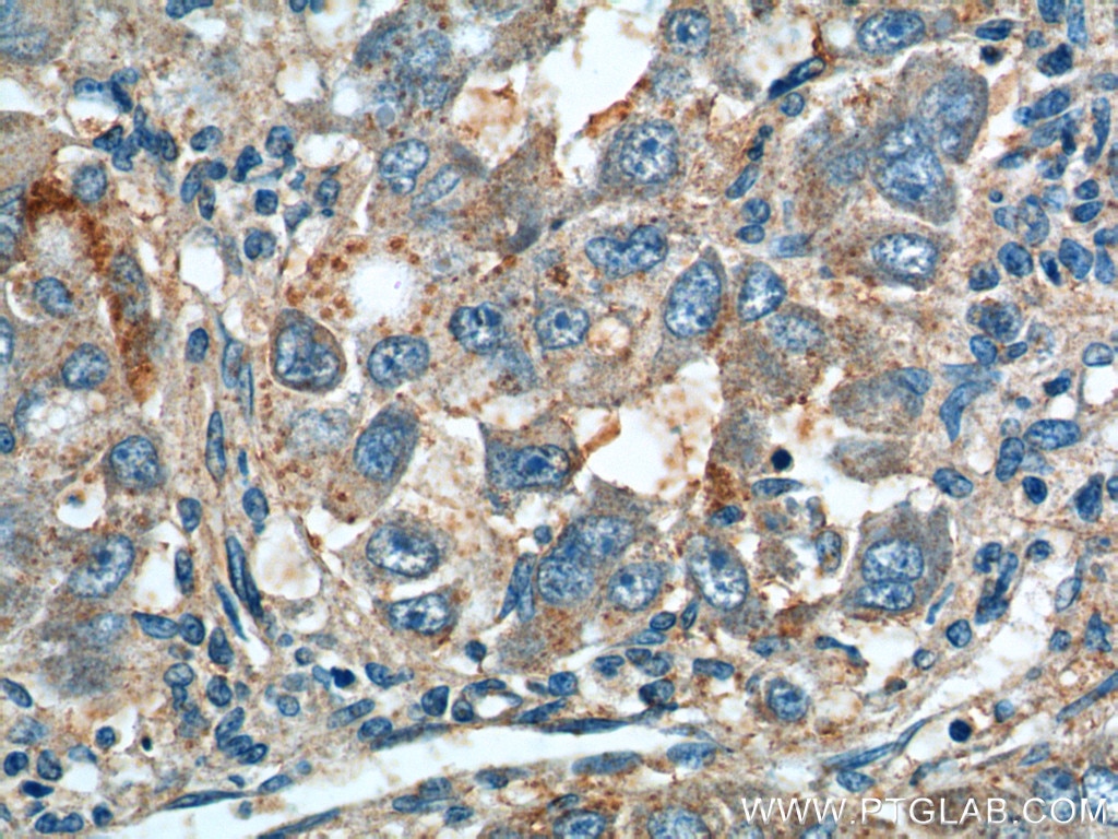Immunohistochemistry (IHC) staining of human liver cancer tissue using ANGPTL8/Betatrophin Polyclonal antibody (23792-1-AP)