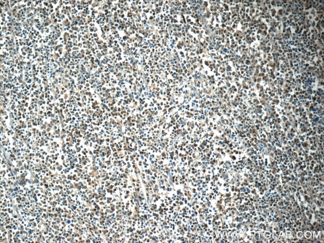Immunohistochemistry (IHC) staining of human lymphoma tissue using MEF2BNB Polyclonal antibody (10931-1-AP)