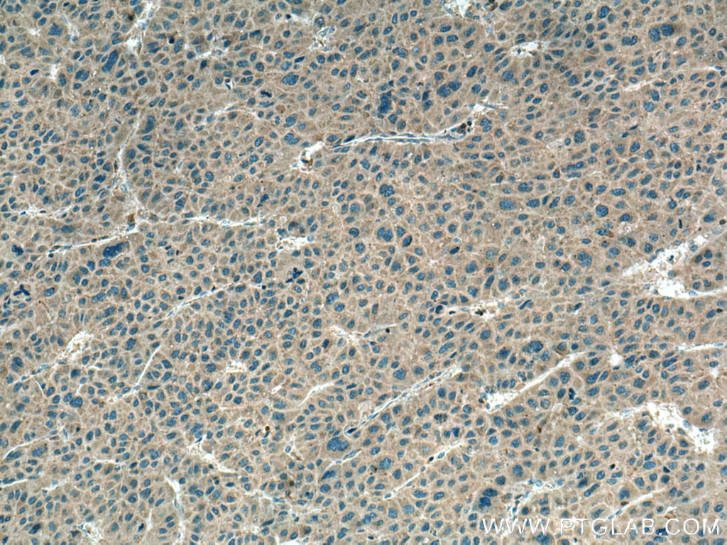 Immunohistochemistry (IHC) staining of human liver cancer tissue using LOH12CR1 Polyclonal antibody (17169-1-AP)