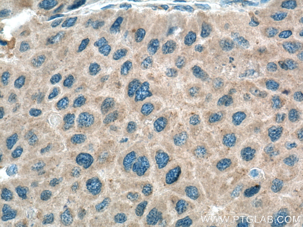 Immunohistochemistry (IHC) staining of human liver cancer tissue using LOH12CR1 Polyclonal antibody (17169-1-AP)