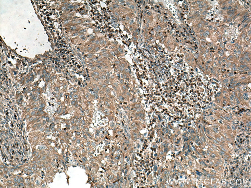 Immunohistochemistry (IHC) staining of human lung cancer tissue using LOH12CR1 Polyclonal antibody (17169-1-AP)