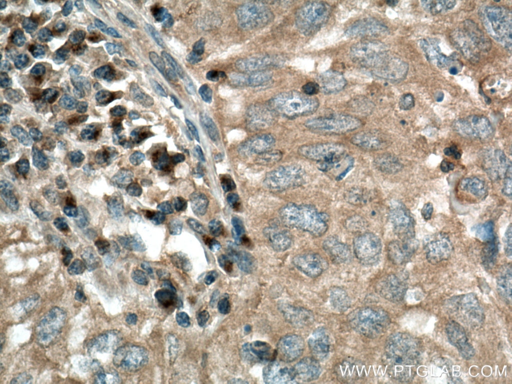 Immunohistochemistry (IHC) staining of human lung cancer tissue using LOH12CR1 Polyclonal antibody (17169-1-AP)