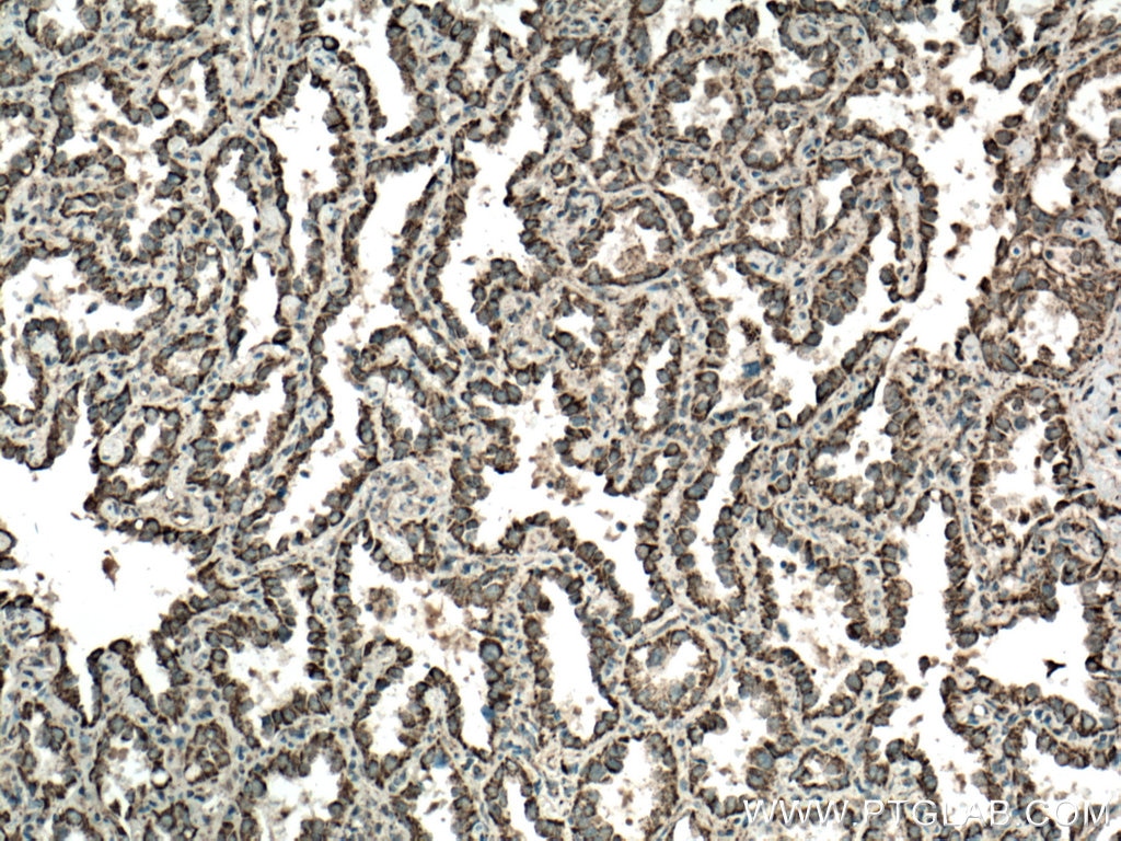 Immunohistochemistry (IHC) staining of human lung cancer tissue using LONP1 Polyclonal antibody (15440-1-AP)