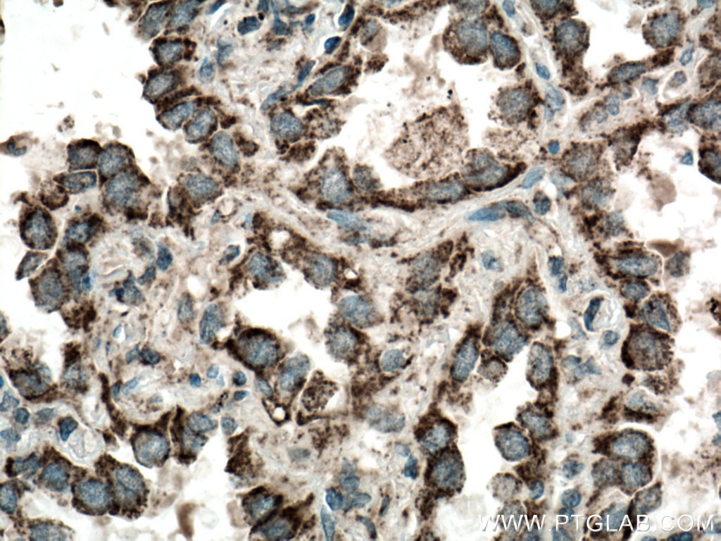 Immunohistochemistry (IHC) staining of human lung cancer tissue using LONP1 Polyclonal antibody (15440-1-AP)