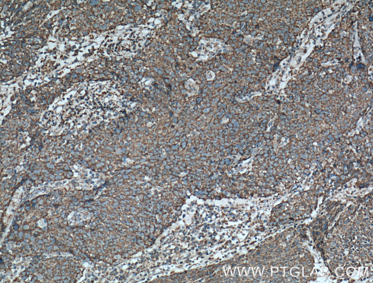 Immunohistochemistry (IHC) staining of human lung cancer tissue using LONP1 Polyclonal antibody (15440-1-AP)