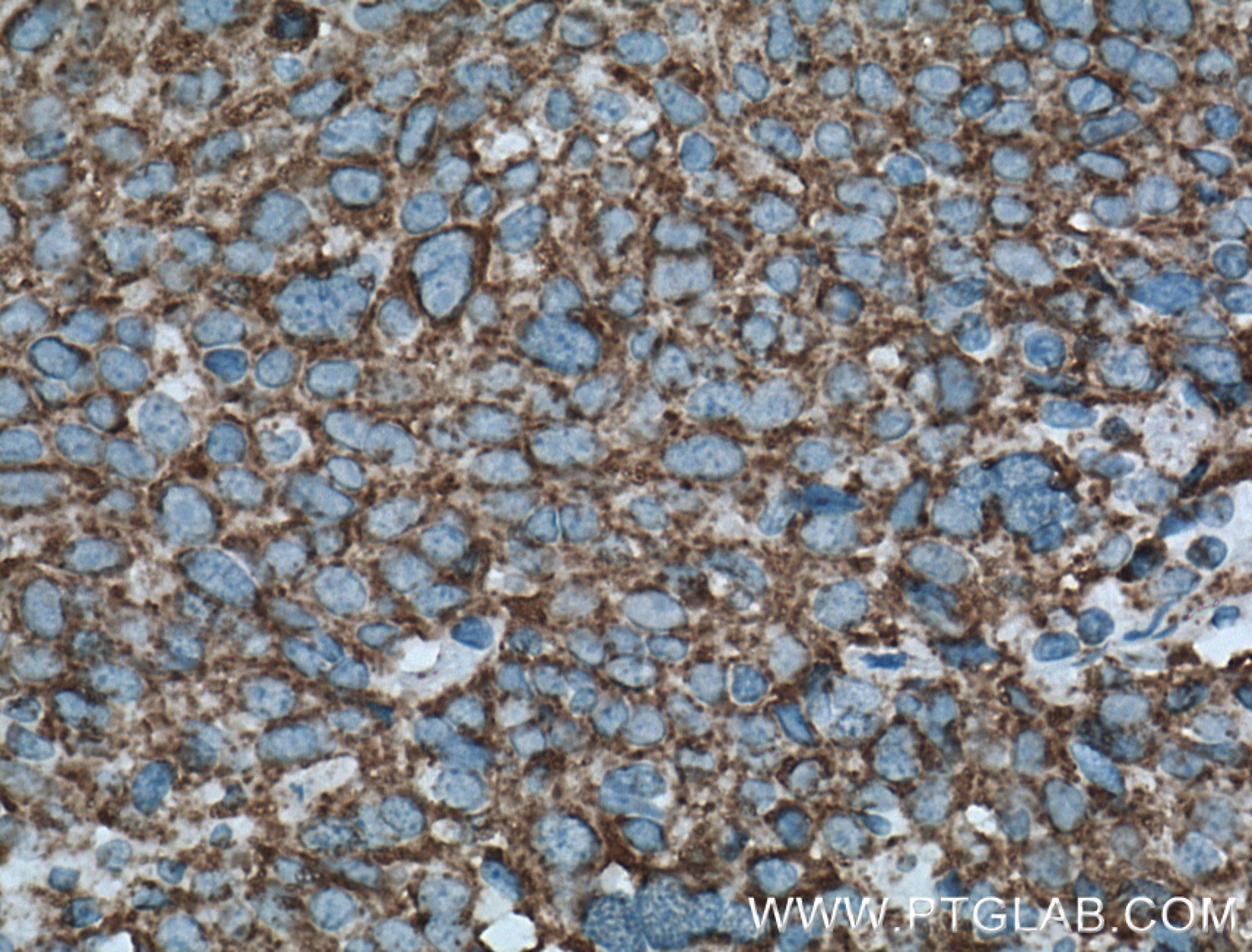 Immunohistochemistry (IHC) staining of human lung cancer tissue using LONP1 Polyclonal antibody (15440-1-AP)