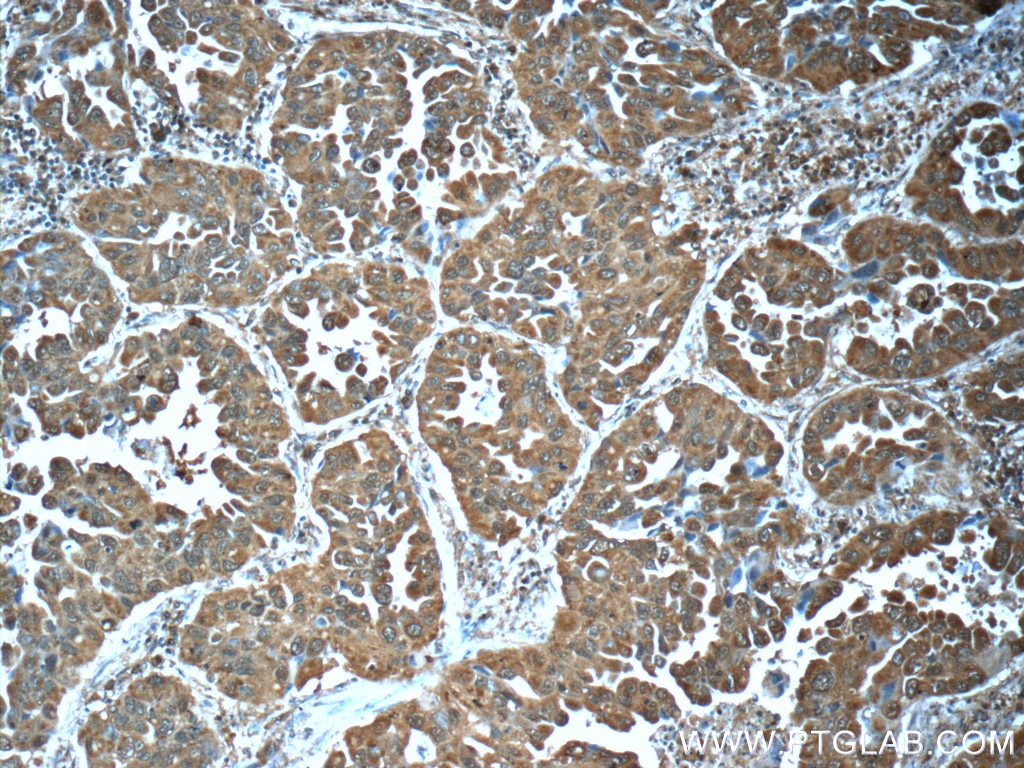 Immunohistochemistry (IHC) staining of human lung cancer tissue using LONP1 Monoclonal antibody (66043-1-Ig)