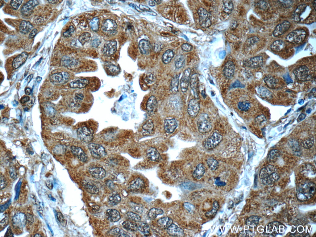 Immunohistochemistry (IHC) staining of human lung cancer tissue using LONP1 Monoclonal antibody (66043-1-Ig)