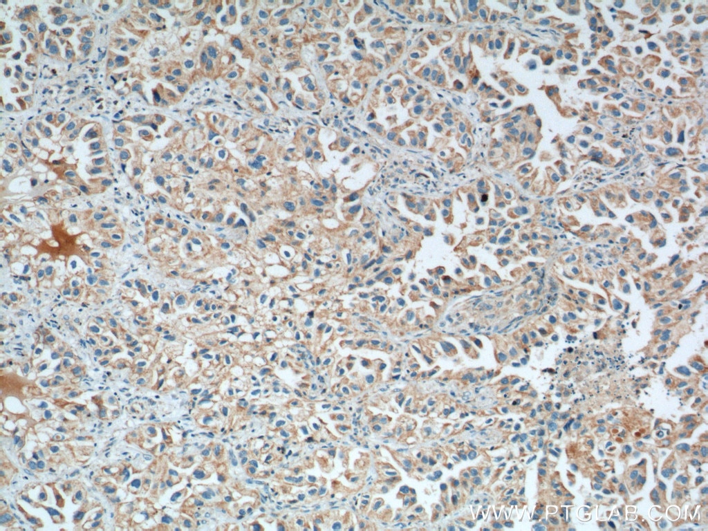 Immunohistochemistry (IHC) staining of human lung cancer tissue using LONP1 Monoclonal antibody (66043-1-Ig)