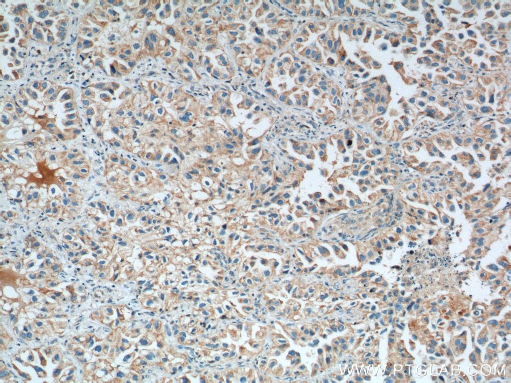 IHC staining of human lung cancer using 66043-1-Ig