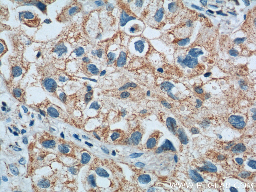 Immunohistochemistry (IHC) staining of human lung cancer tissue using LONP1 Monoclonal antibody (66043-1-Ig)