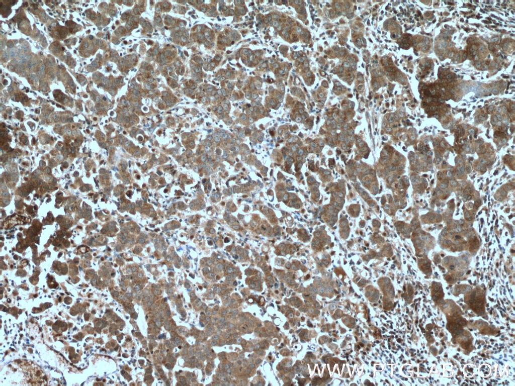 Immunohistochemistry (IHC) staining of human prostate cancer tissue using LONP2 Polyclonal antibody (18035-1-AP)