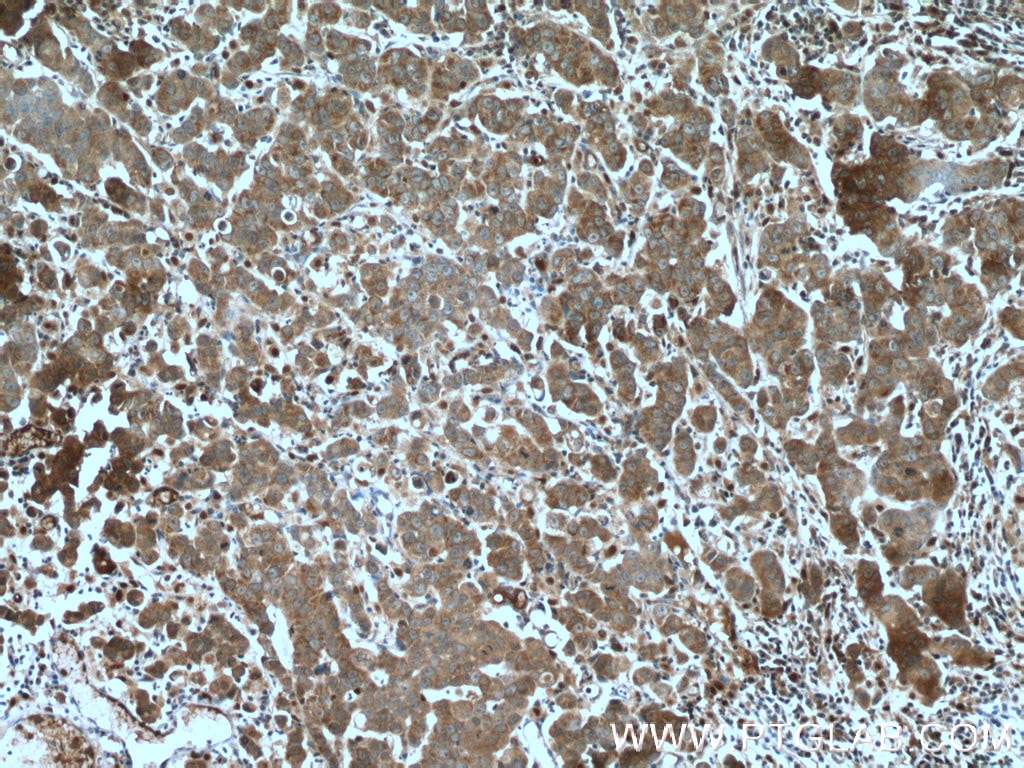 IHC staining of human prostate cancer using 18035-1-AP