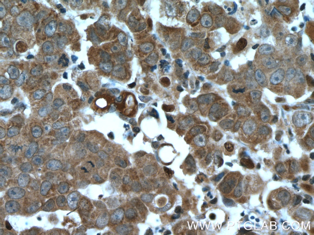 Immunohistochemistry (IHC) staining of human prostate cancer tissue using LONP2 Polyclonal antibody (18035-1-AP)