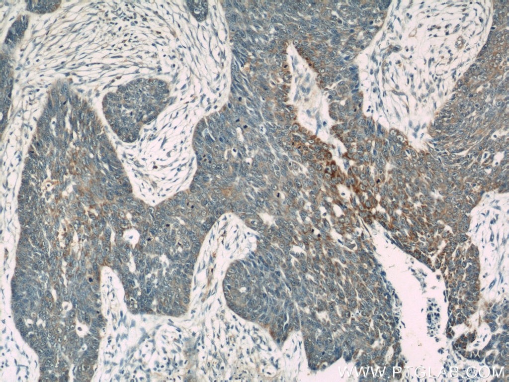 Immunohistochemistry (IHC) staining of human skin cancer tissue using Loricrin Polyclonal antibody (55439-1-AP)
