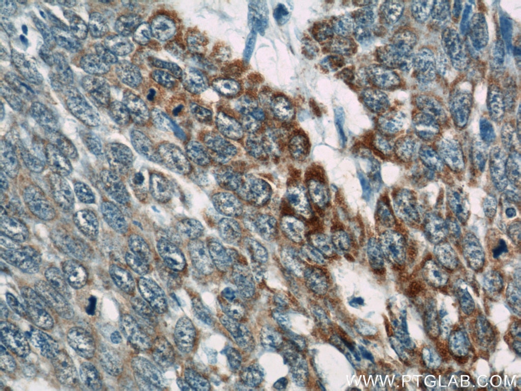 Immunohistochemistry (IHC) staining of human skin cancer tissue using Loricrin Polyclonal antibody (55439-1-AP)
