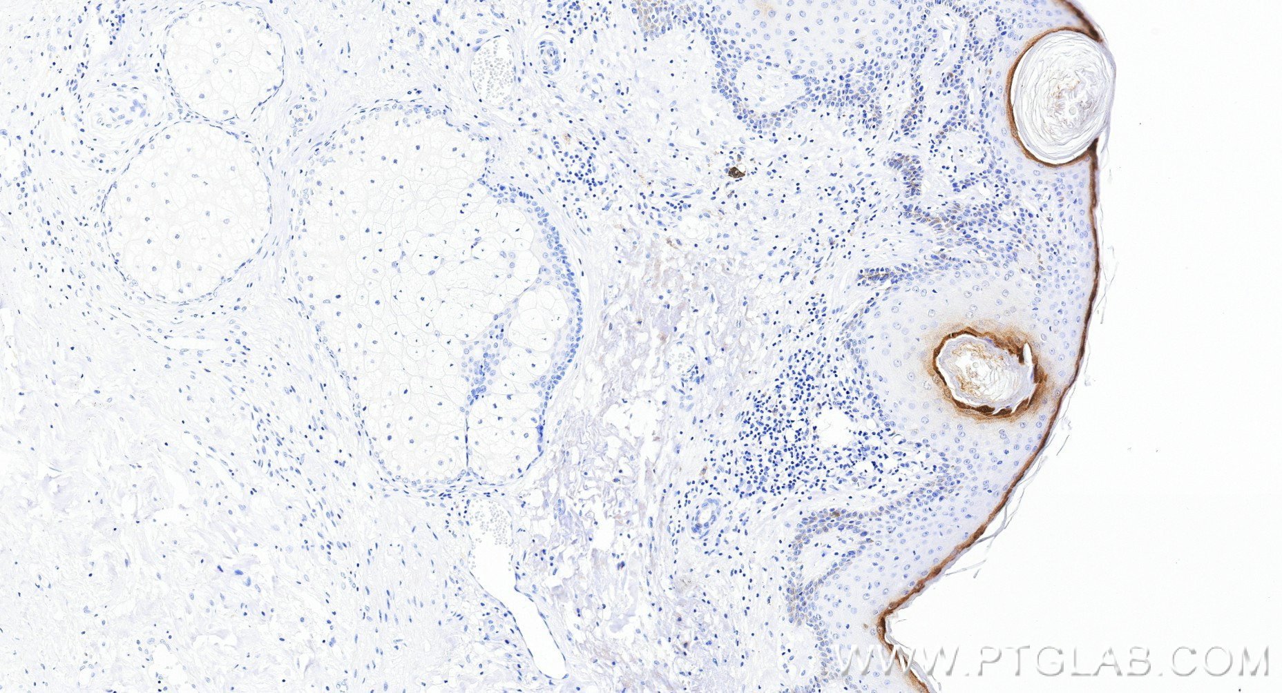 Immunohistochemistry (IHC) staining of human skin tissue using Loricrin Recombinant monoclonal antibody (83865-2-RR)
