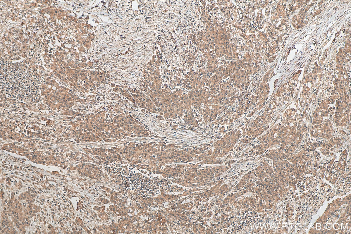Immunohistochemistry (IHC) staining of human stomach cancer tissue using LOX Polyclonal antibody (17958-1-AP)
