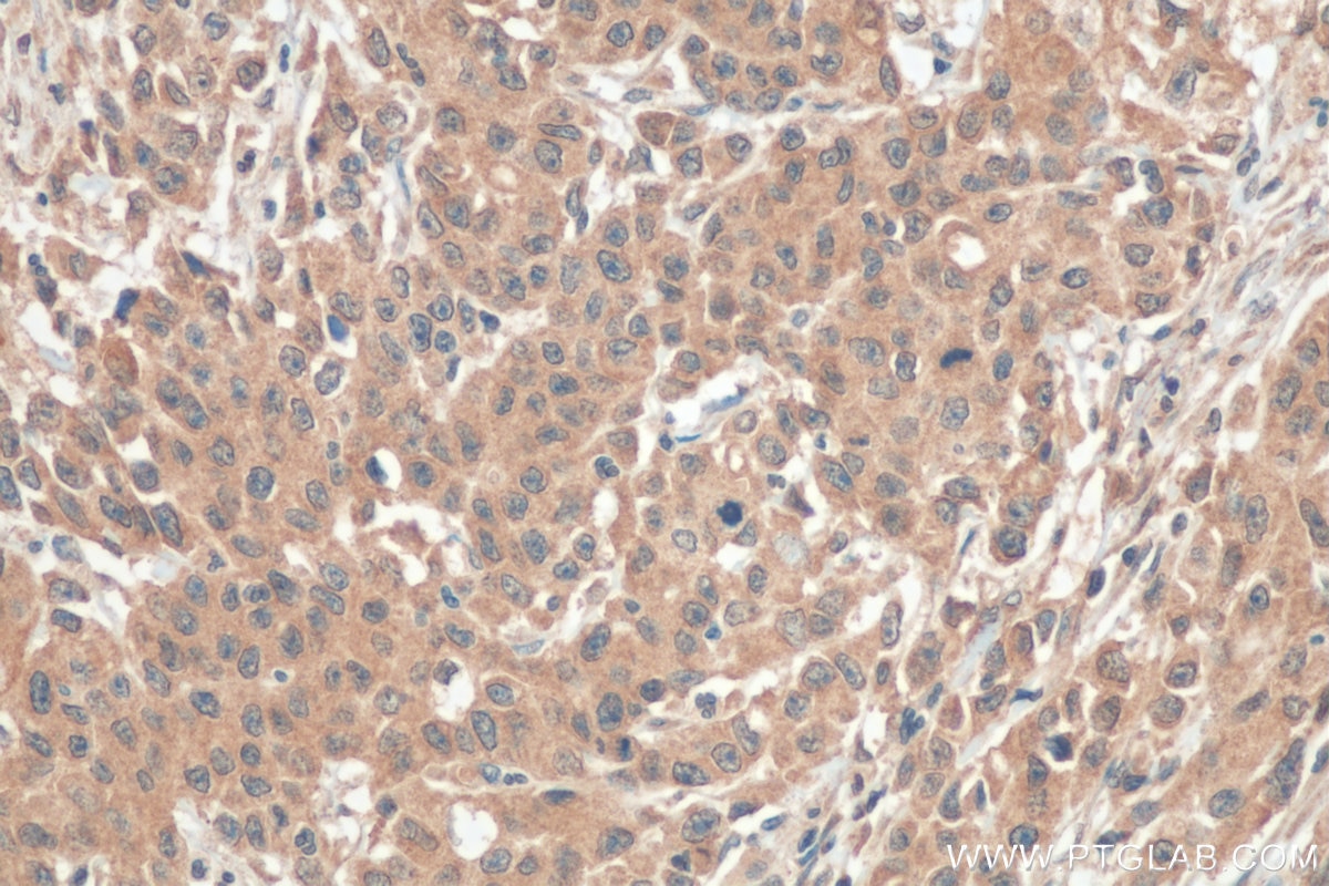 Immunohistochemistry (IHC) staining of human stomach cancer tissue using LOX Polyclonal antibody (17958-1-AP)