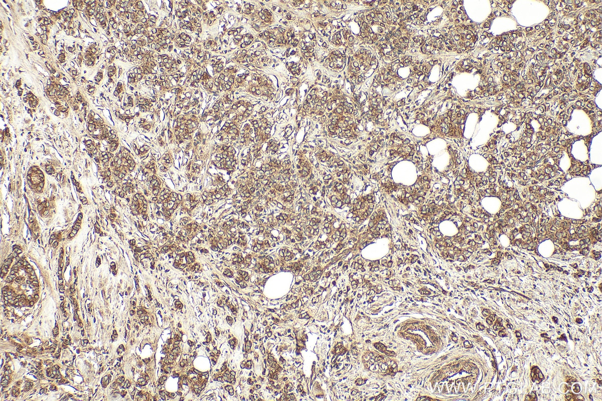 IHC staining of human breast cancer using 15232-1-AP Immunohistochemistry (IHC) staining of human breast cancer tissue using LOXL2 Polyclonal antibody (15232-1-AP)