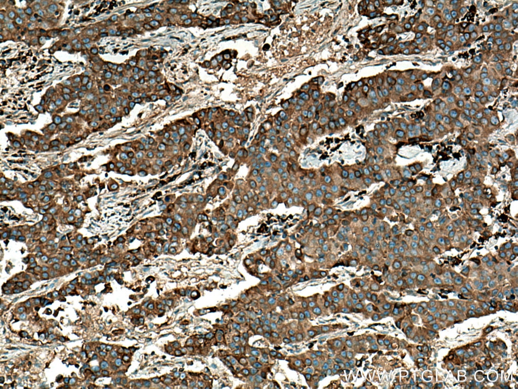 Immunohistochemistry (IHC) staining of human breast cancer tissue using LPCAT1 Polyclonal antibody (16112-1-AP)