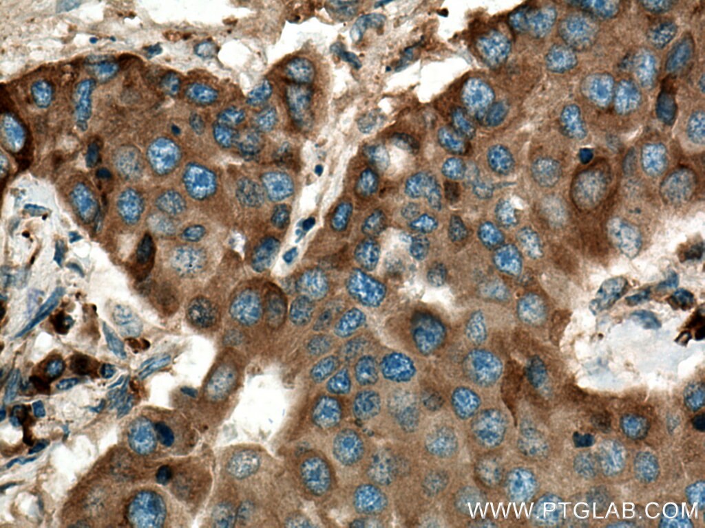 Immunohistochemistry (IHC) staining of human breast cancer tissue using LPCAT1 Polyclonal antibody (16112-1-AP)