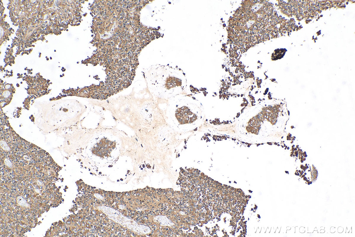 Immunohistochemistry (IHC) staining of human colon cancer tissue using LPCAT1 Polyclonal antibody (16112-1-AP)