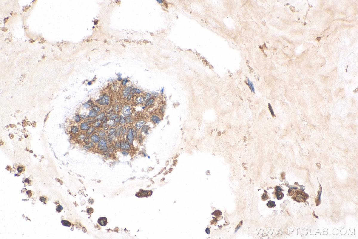 Immunohistochemistry (IHC) staining of human colon cancer tissue using LPCAT1 Polyclonal antibody (16112-1-AP)