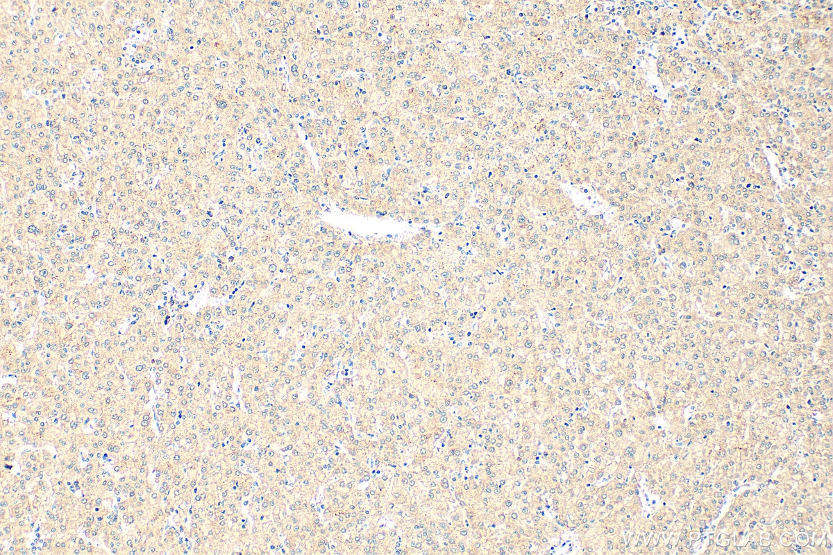 Immunohistochemistry (IHC) staining of human liver cancer tissue using LPCAT1 Monoclonal antibody (66044-1-Ig)