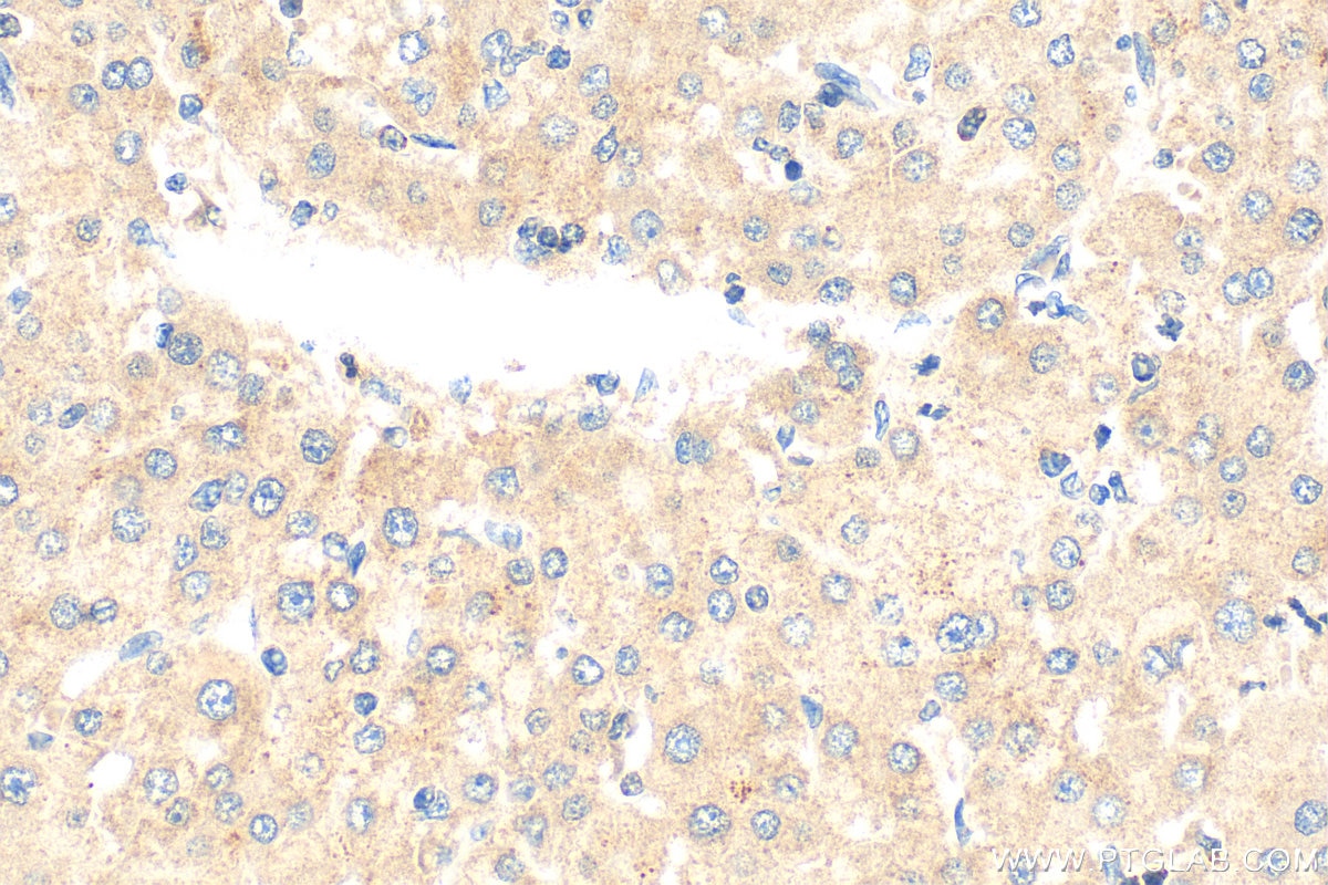 Immunohistochemistry (IHC) staining of human liver cancer tissue using LPCAT1 Monoclonal antibody (66044-1-Ig)