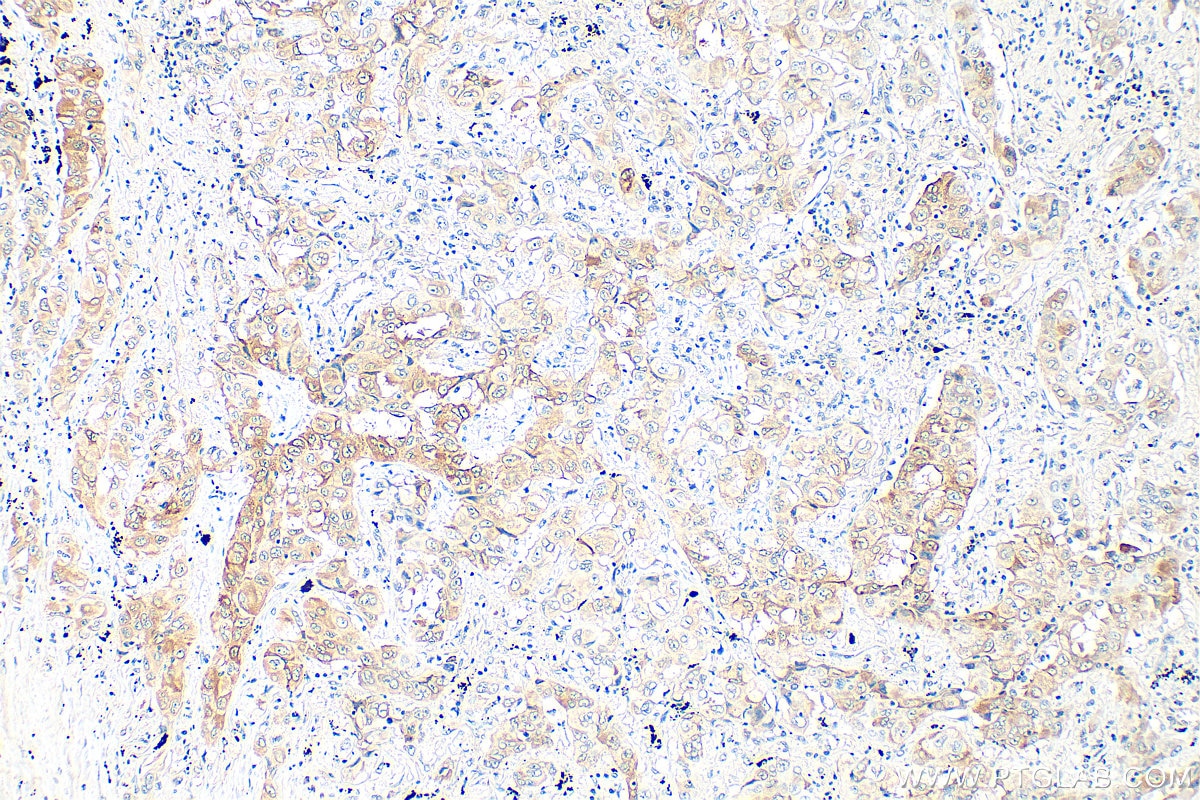 Immunohistochemistry (IHC) staining of human lung cancer tissue using LPCAT1 Monoclonal antibody (66044-1-Ig)
