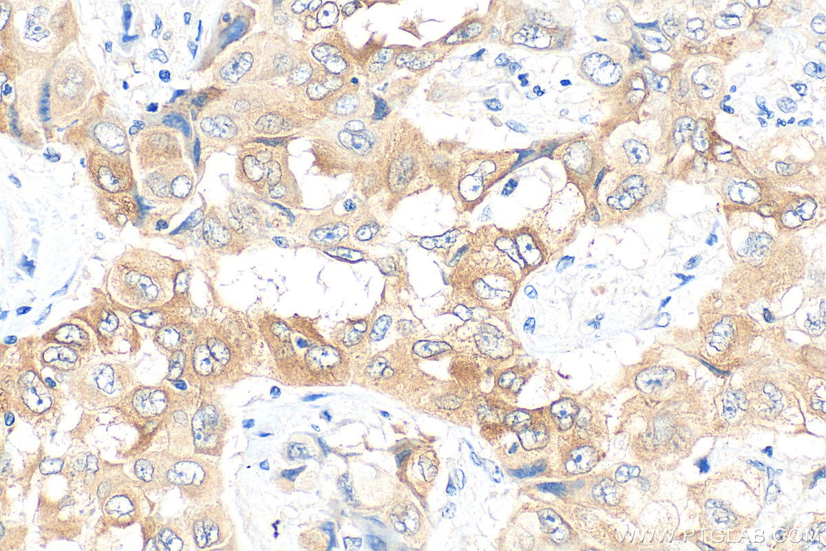Immunohistochemistry (IHC) staining of human lung cancer tissue using LPCAT1 Monoclonal antibody (66044-1-Ig)