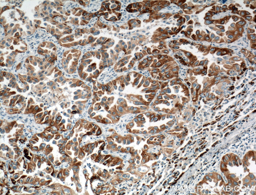 Immunohistochemistry (IHC) staining of human lung cancer tissue using LPCAT1 Monoclonal antibody (66044-1-Ig)