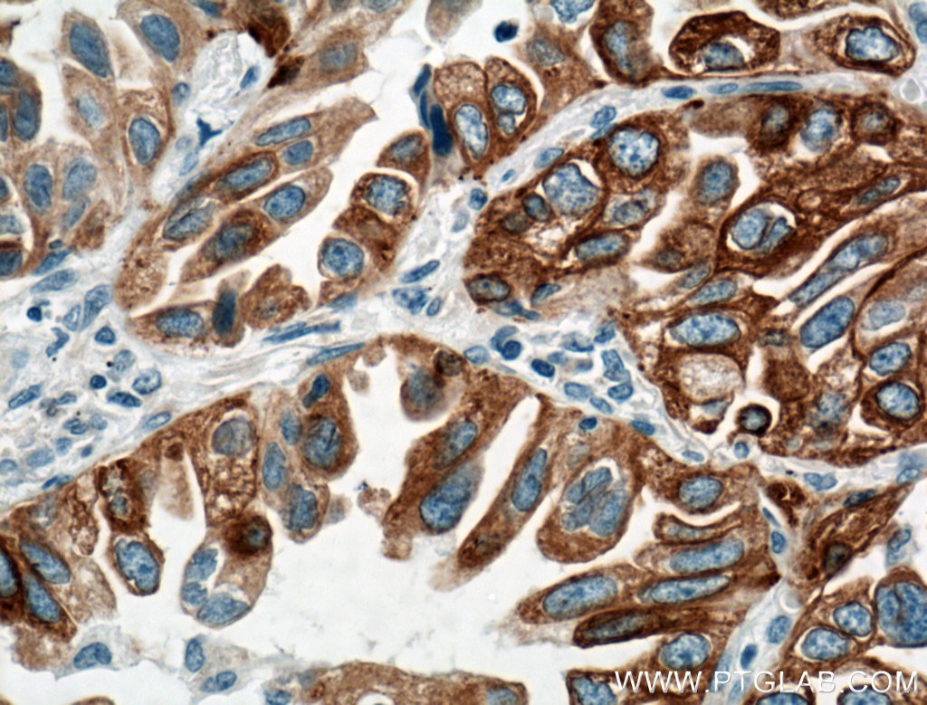 Immunohistochemistry (IHC) staining of human lung cancer tissue using LPCAT1 Monoclonal antibody (66044-1-Ig)