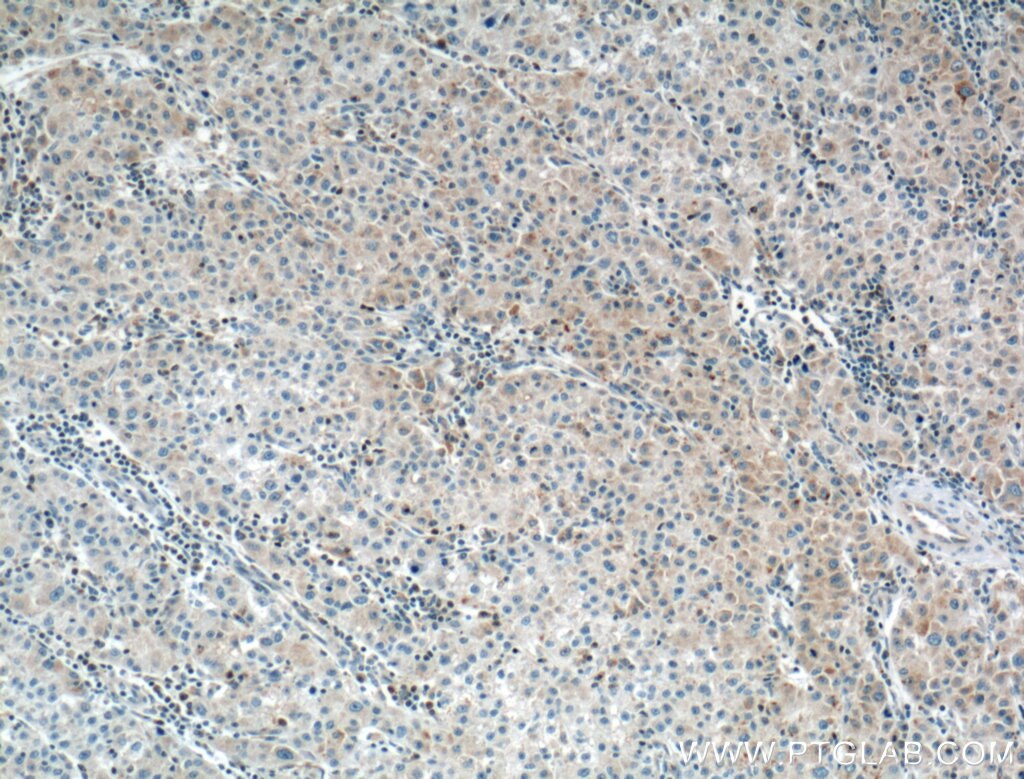 IHC staining of human liver cancer using 66044-1-Ig