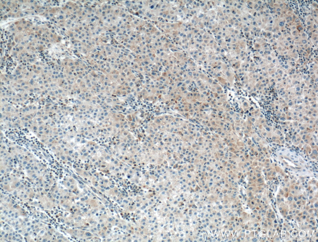 Immunohistochemistry (IHC) staining of human liver cancer tissue using LPCAT1 Monoclonal antibody (66044-1-Ig)