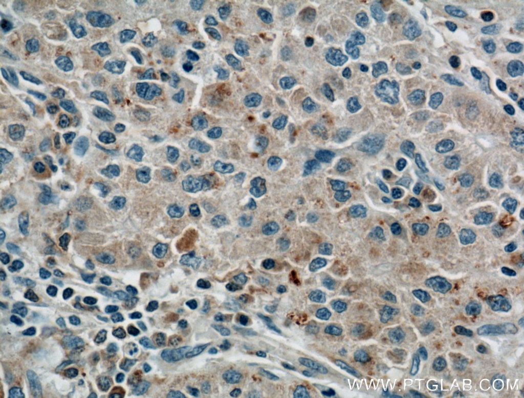 Immunohistochemistry (IHC) staining of human liver cancer tissue using LPCAT1 Monoclonal antibody (66044-1-Ig)