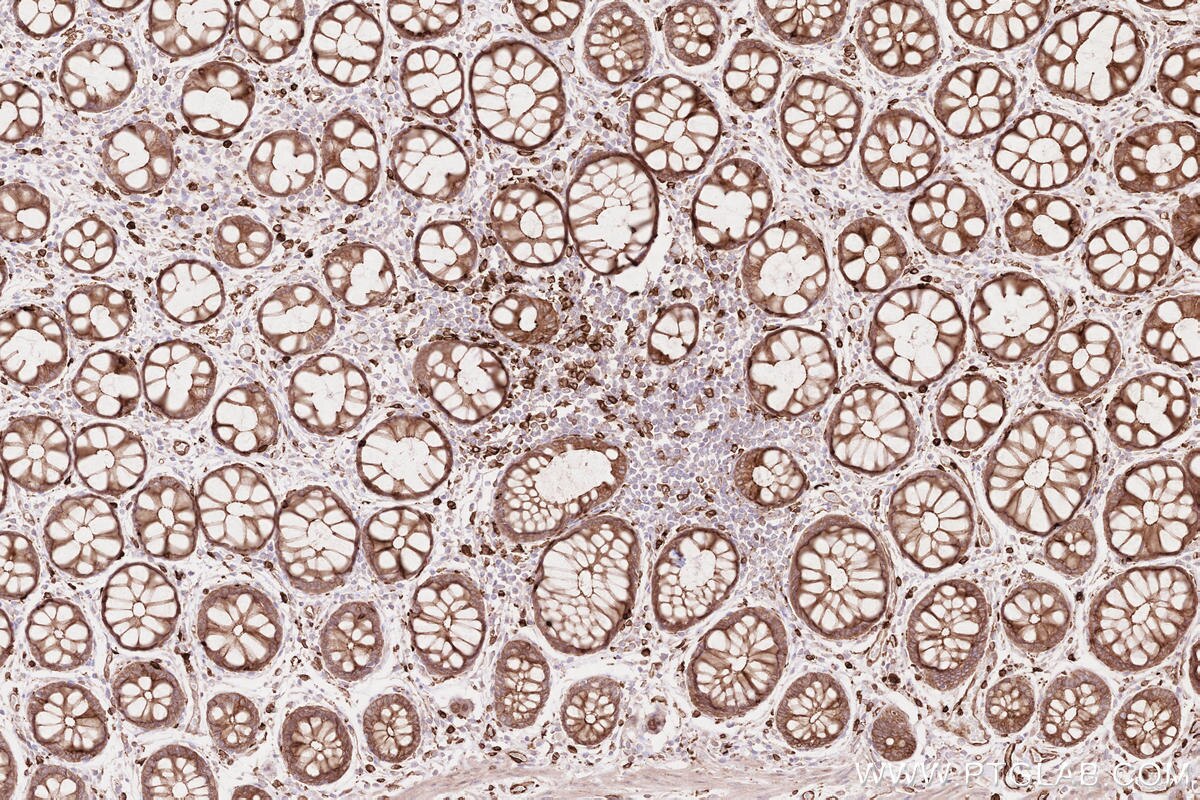 Immunohistochemistry (IHC) staining of human rectal cancer tissue using LPCAT2 Polyclonal antibody (15082-1-AP)