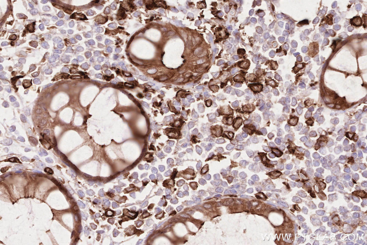 Immunohistochemistry (IHC) staining of human rectal cancer tissue using LPCAT2 Polyclonal antibody (15082-1-AP)