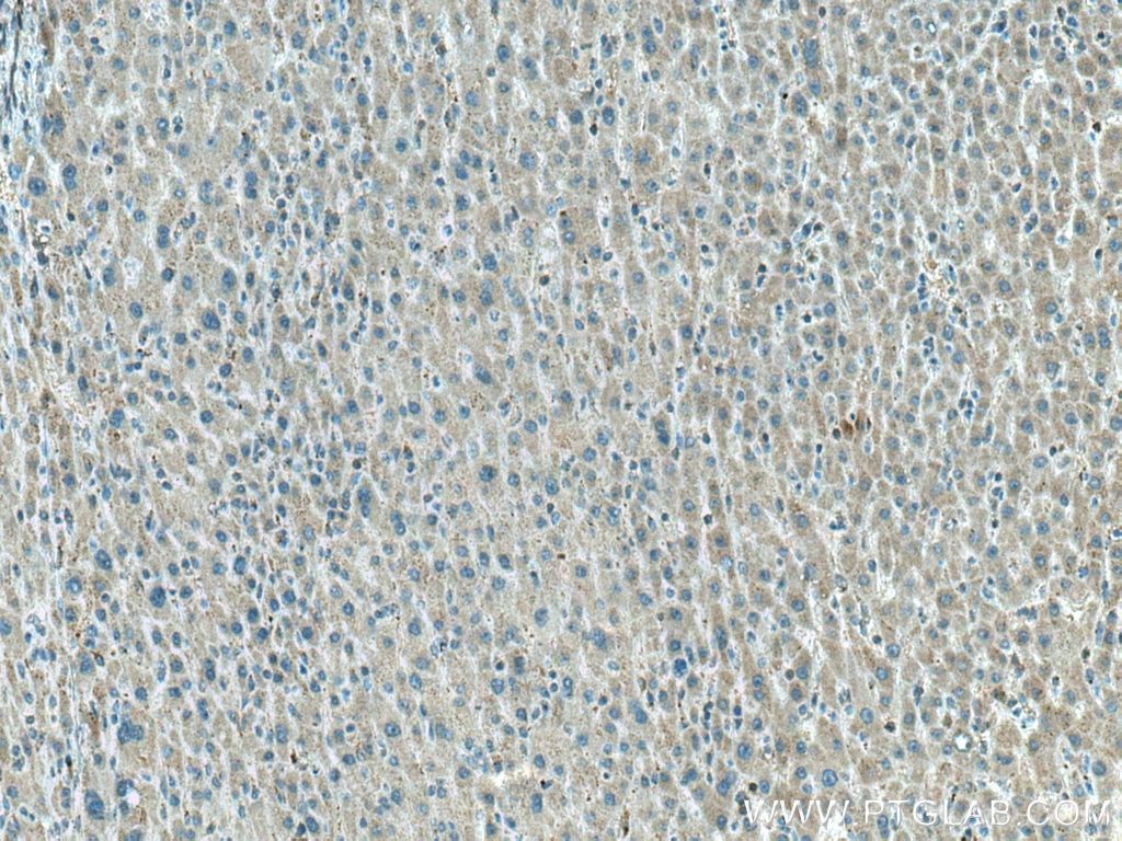 IHC staining of human liver cancer using 27026-1-AP
