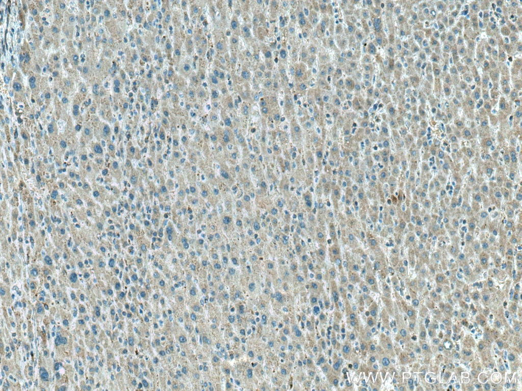 Immunohistochemistry (IHC) staining of human liver cancer tissue using LPIN1 Polyclonal antibody (27026-1-AP)