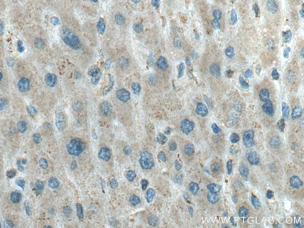 Immunohistochemistry (IHC) staining of human liver cancer tissue using LPIN1 Polyclonal antibody (27026-1-AP)