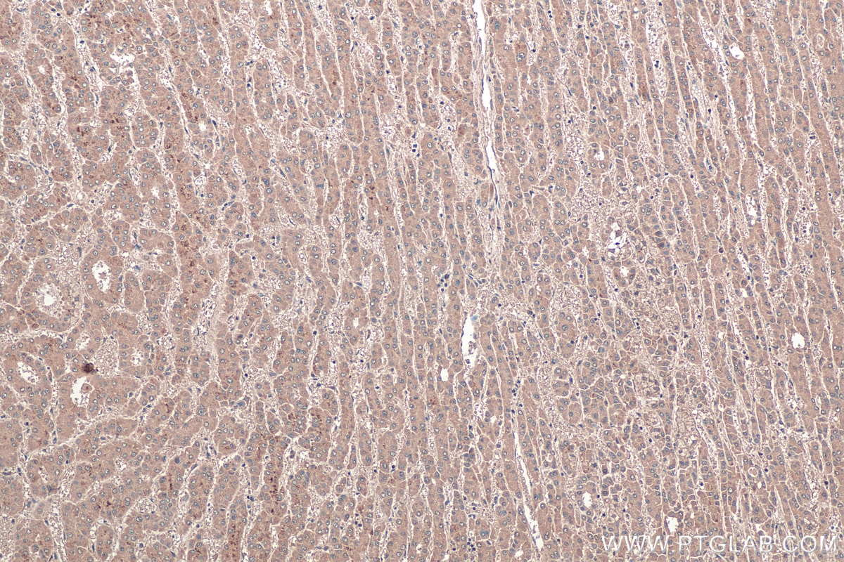 Immunohistochemistry (IHC) staining of human liver cancer tissue using LPIN1 Monoclonal antibody (68124-1-Ig)