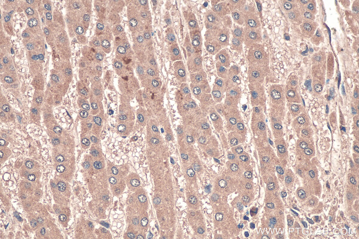 IHC staining of human liver cancer using 68124-1-Ig