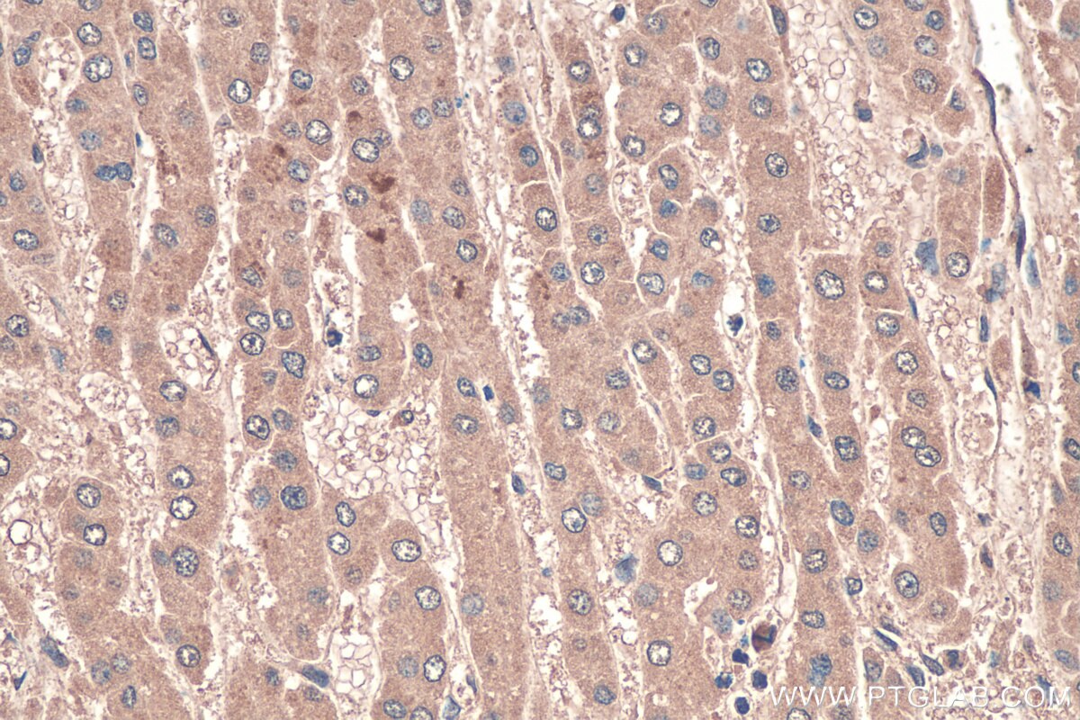 Immunohistochemistry (IHC) staining of human liver cancer tissue using LPIN1 Monoclonal antibody (68124-1-Ig)