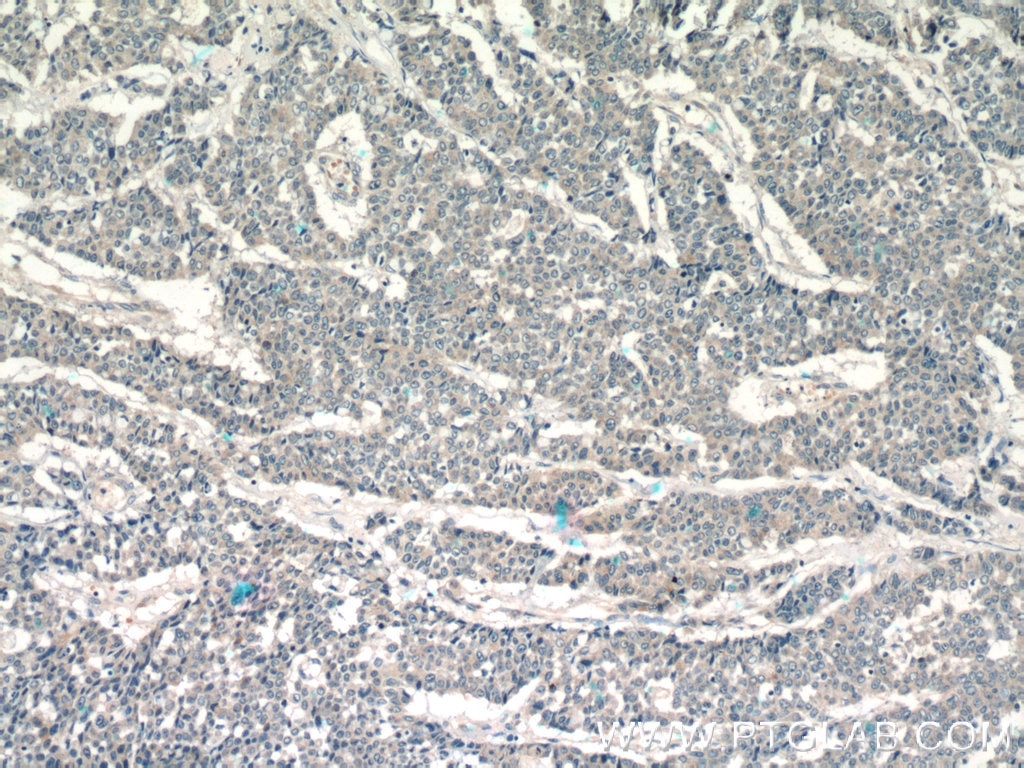 Immunohistochemistry (IHC) staining of human colon cancer tissue using LPO Polyclonal antibody (10376-1-AP)