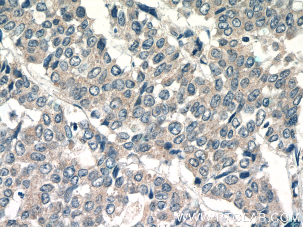 Immunohistochemistry (IHC) staining of human colon cancer tissue using LPO Polyclonal antibody (10376-1-AP)