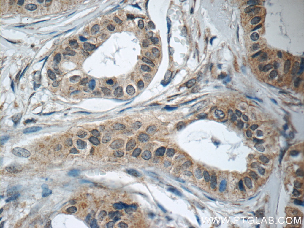 Immunohistochemistry (IHC) staining of human breast cancer tissue using LPO Polyclonal antibody (10376-1-AP)