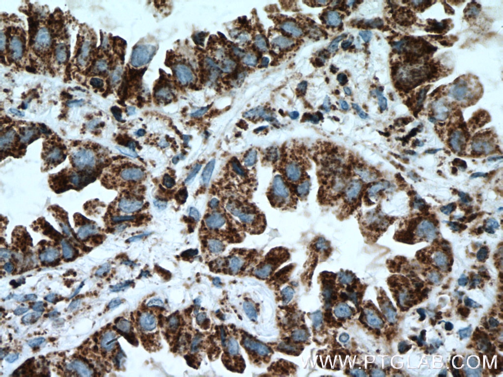 Immunohistochemistry (IHC) staining of human lung cancer tissue using LPXN Polyclonal antibody (11307-1-AP)