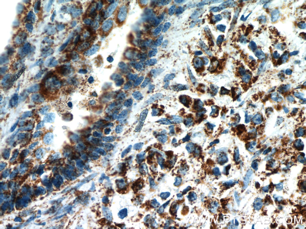 Immunohistochemistry (IHC) staining of human prostate cancer tissue using LPXN Polyclonal antibody (11307-1-AP)